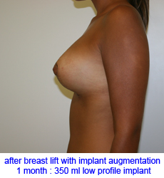 plastic-surgery-breast-lift-augmentation